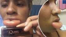 bibir wanita bengkak karena reaksi alergi terhadap lipstick
