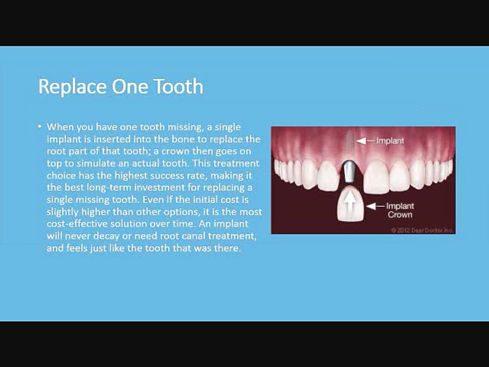 Tooth Replacement Options Using Dental Implants