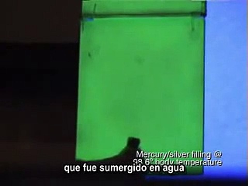 AMALGAMAS DE MERCURIO- DAÑOS A LA SALUD