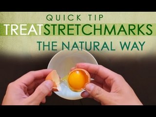 The Alternative - EP21 - Treat Stretch Marks - Myx TV