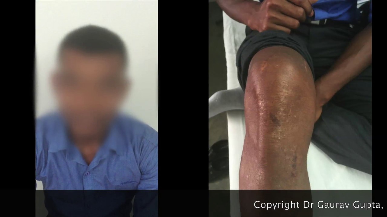 PCL(Posterior cruciate ligament)