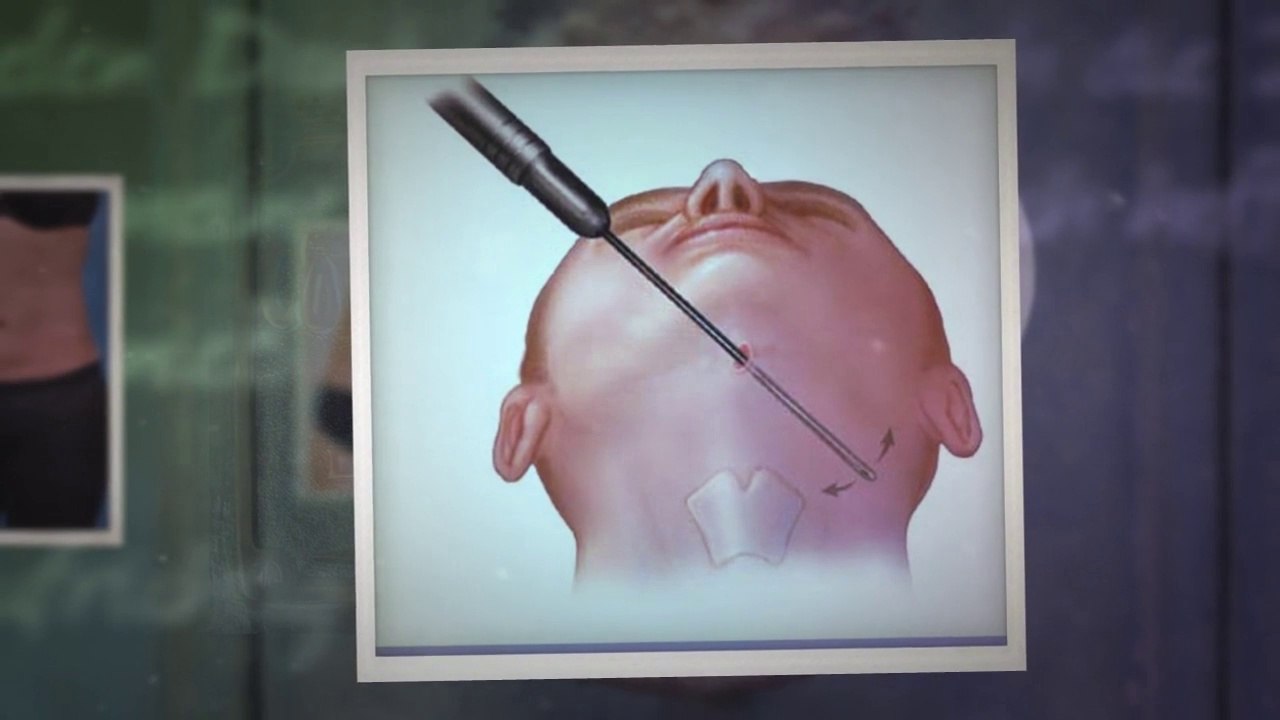 liposuction and tummy tuck