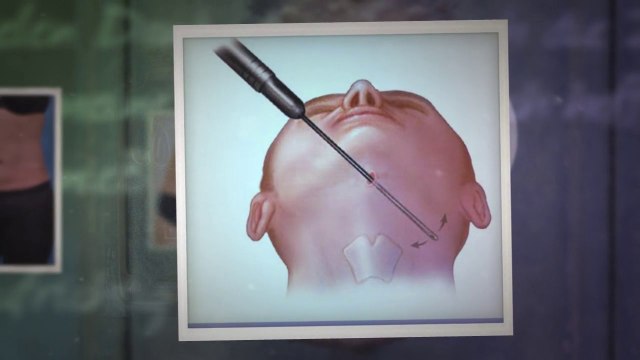 liposuction and tummy tuck