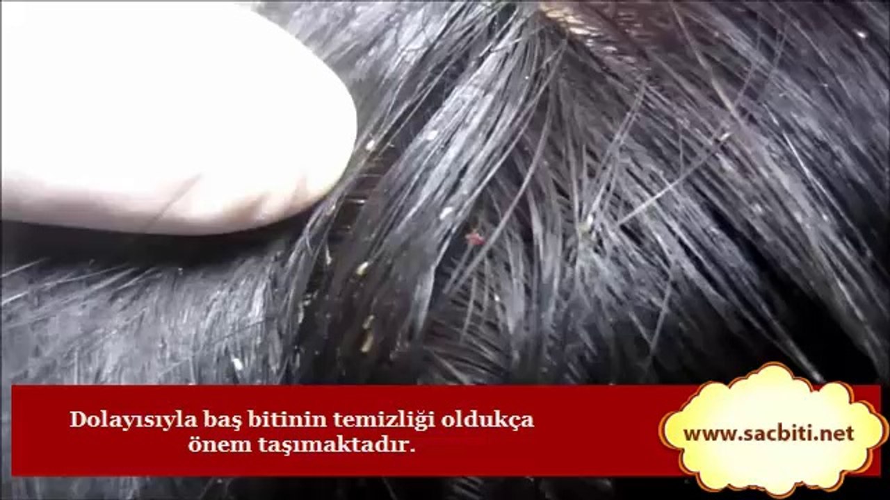 İnsan Başında Yüzlerce Saç Biti Olabilir