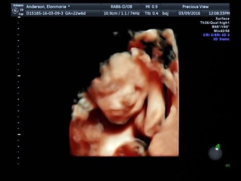 3D/4D/HD Live Ultrasound @ 22 weeks of our Maddy