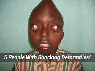 5 People With Extremely Shocking Deformities!