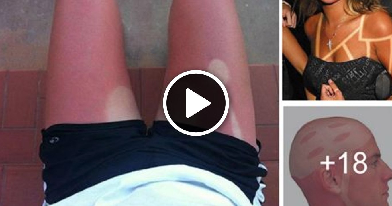 Una compilation di abbronzature imbarazzanti