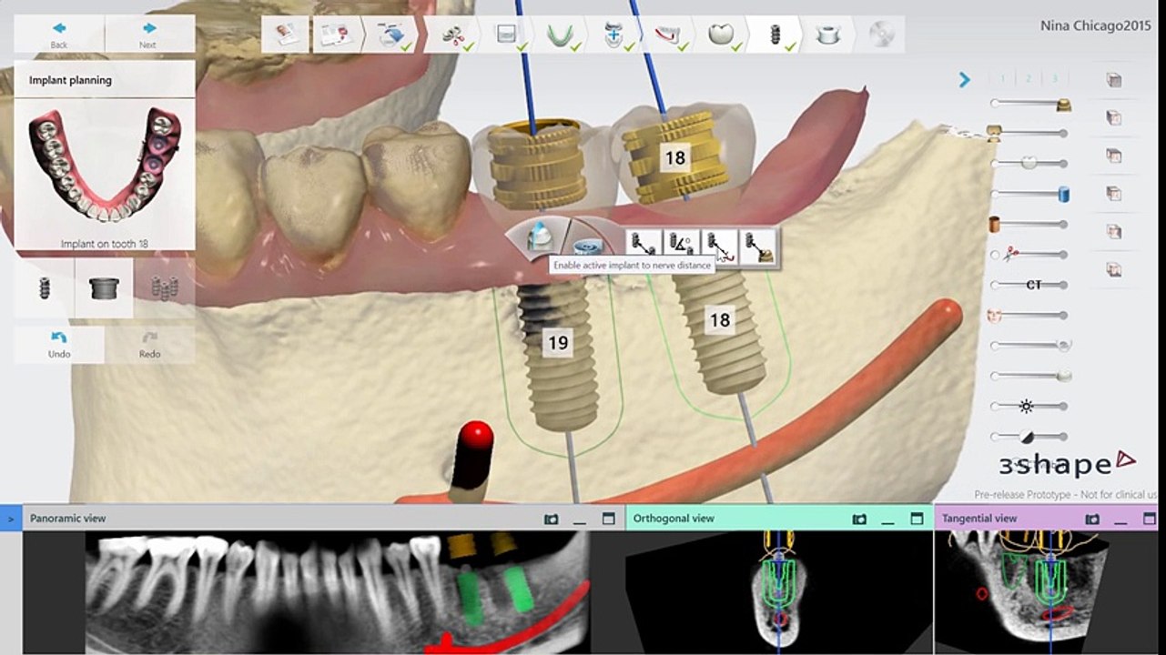 A preview of Implant Studio