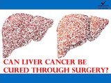 Is Surgery an Effectual Treatment for Liver Cancer?