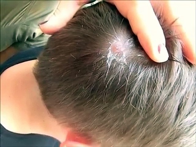 Huge Botfly Maggot Removed from Head