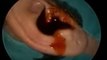 Oto-endoscopic Removal of Forgotten Stuck Ear bud from Ear Canal