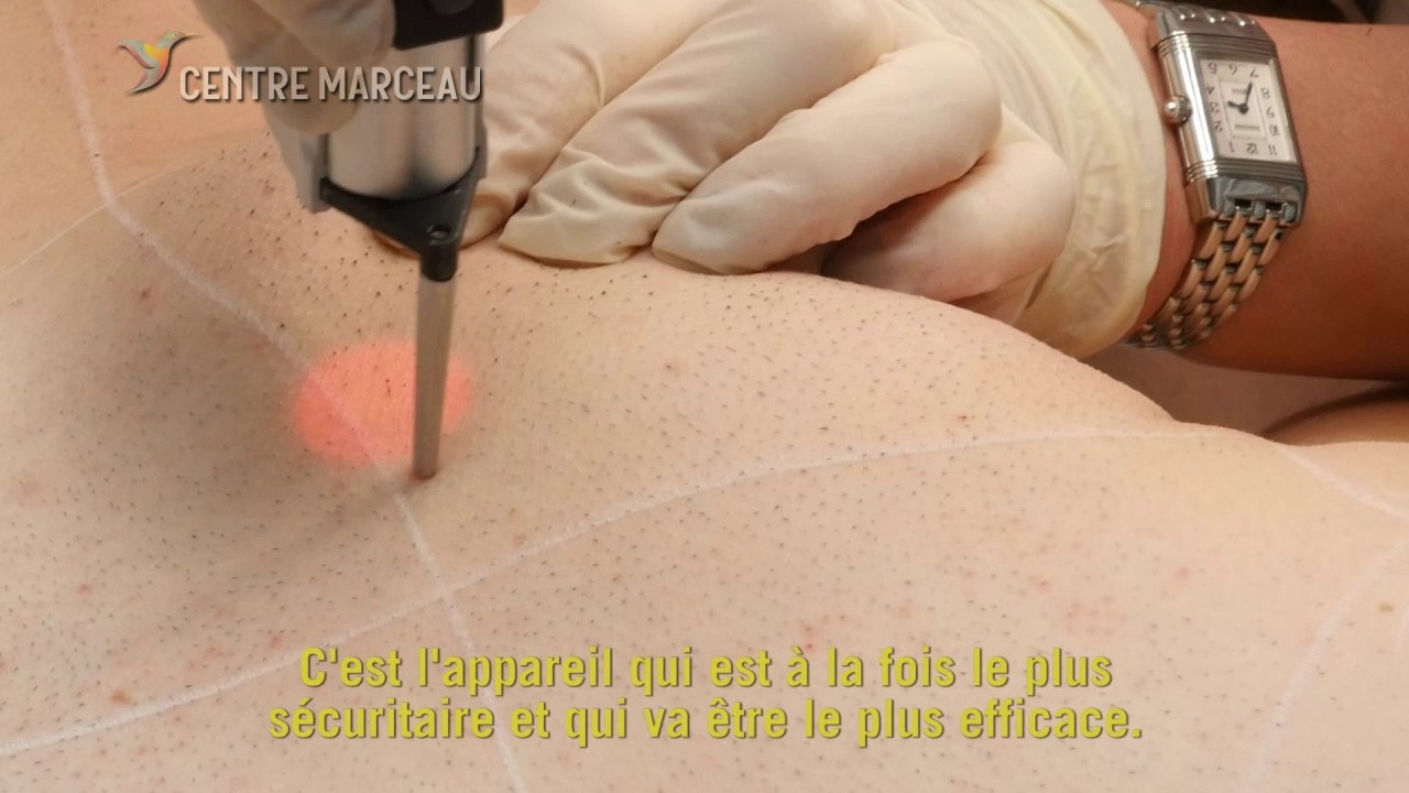TYPES DE LASER POUR UNE EPILATION DEFINITIVE