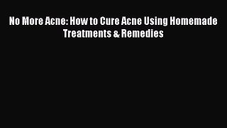 READ book No More Acne: How to Cure Acne Using Homemade Treatments & Remedies# Full E-Book