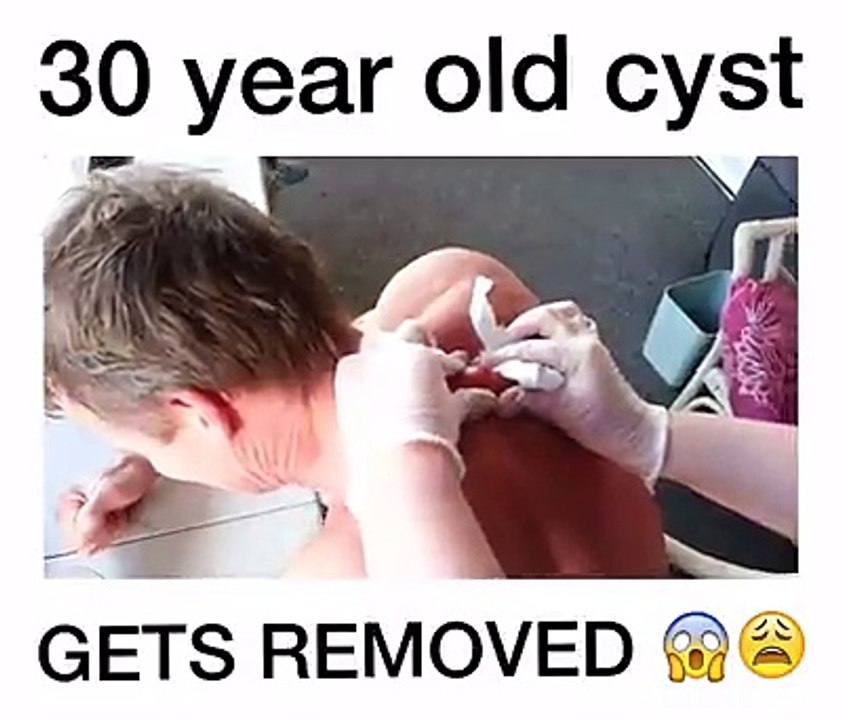 30 YEAR OLD CYST GETS REMOVED