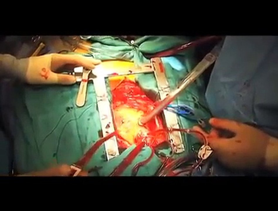 Open Heart Surgery - Live Footage