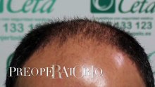 CLINICAS CETA CAPITAL www.injertodepelo.es
