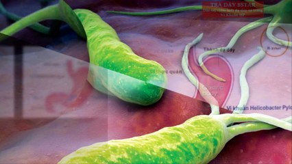 Triệu chứng của nhiễm vi khuẩn HP là gì [tridaubaotu.com]