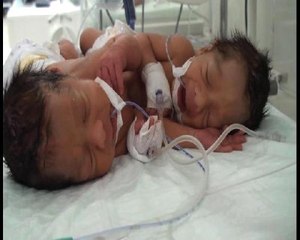 Aynı Karaciğeri Paylaşan Siyam İkizleri Dünyaya Geldi