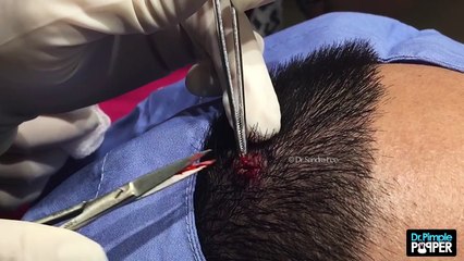 Excising an interesting Pilar Cyst