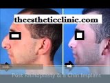 Chin Implant and Augmentation at Facial Plastic Surgeon India