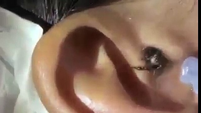 اگر کسی بچے کو کان میں درد محسوس ہو تو اس طرح پانی سے پتا چل جاتا ہے کہ کان میں کیا ہے ۔