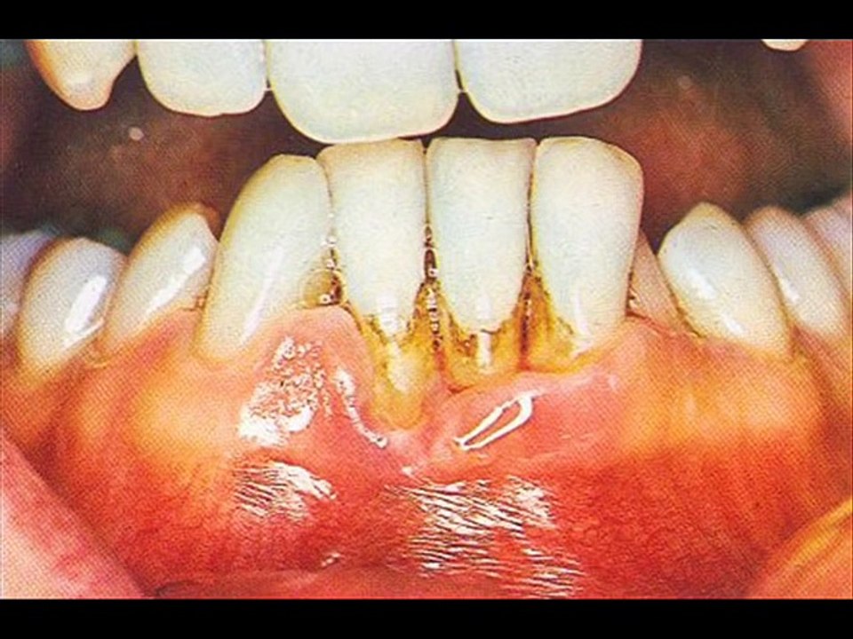 DENTAL INFECTION , HEALTH EDUCATION , INFECTION CONTROL (ICSP) , URDU _ HINDI .