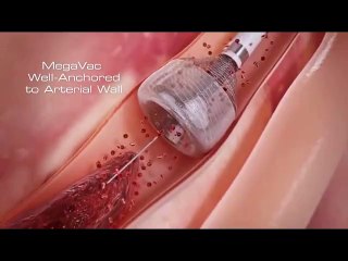 نئی ٹیکنالوجی کیساتھ دل کے بند وال کو اوپن کرنے کا مکمل آپریشن دیکھیں