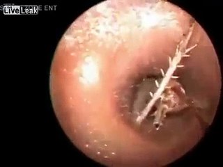 IL A SENTI UNE DOULEUR À L’OREILLE.. MAIS CE QUE LE DOCTEUR LUI A ENLÈVÉ EST VRAIMENT HALLUCINANT