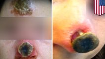 Fake cancer cure: Woman’s nose rots off after using controversial cancer remedy - TomoNews