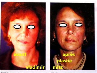 paralysie faciale- infos par vladimir mitz