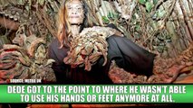 Amazing People With Extreme Body Deformities