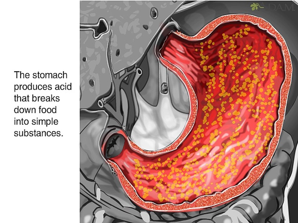 Stomach ulcer