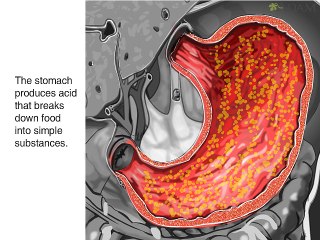 Stomach ulcer