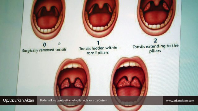 Bademcik ve geniz eti ameliyatlarında kansız yöntem