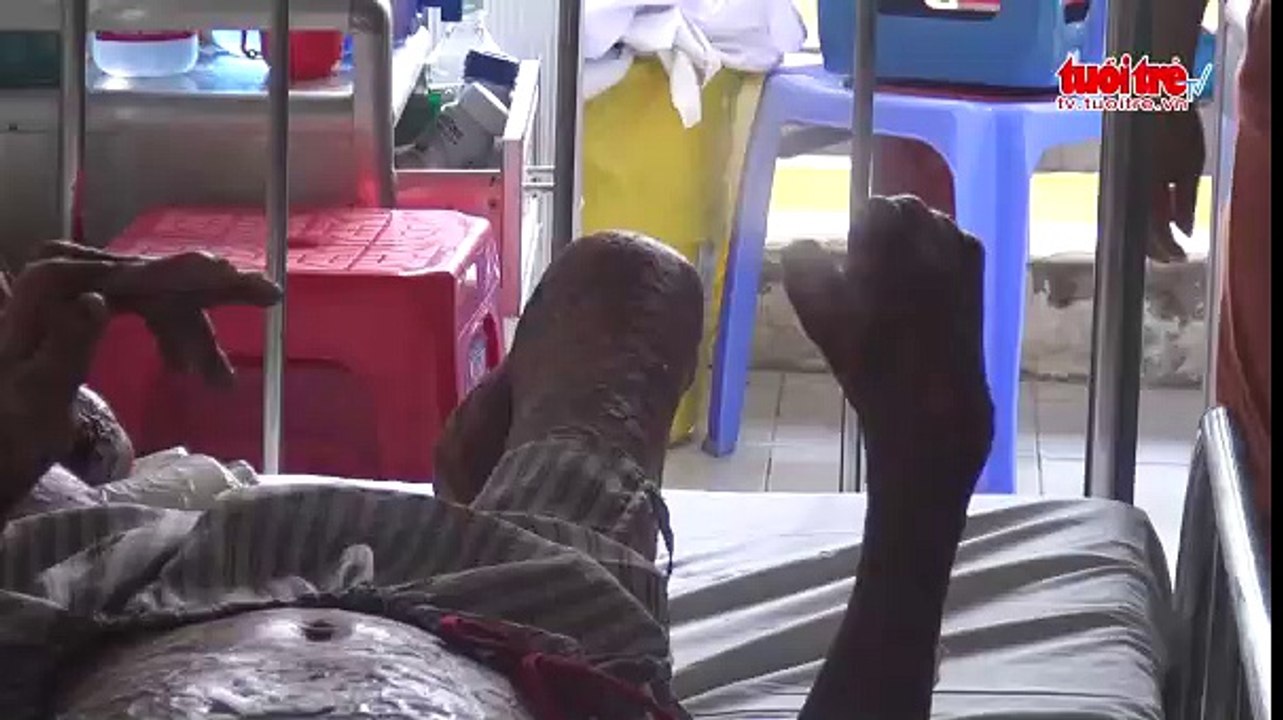 Cứu sống bệnh nhân bỏng xăng 85%