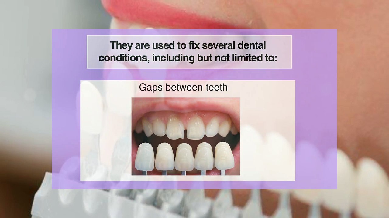 They Match or Improve the Natural Color of the Teath
