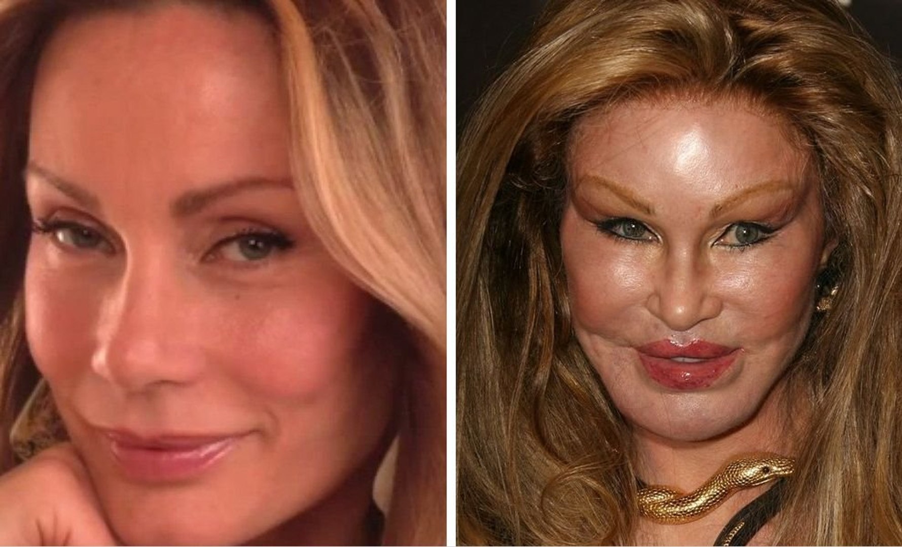 Worst Cases of Celebrity Plastic Surgery Gone Wrong -- Before-And-After Plastic Surgery Disasters