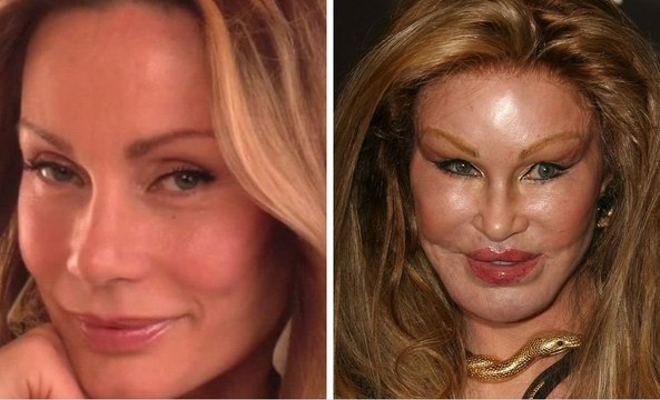 Worst Cases of Celebrity Plastic Surgery Gone Wrong Before-And-After Plastic Surgery Disasters