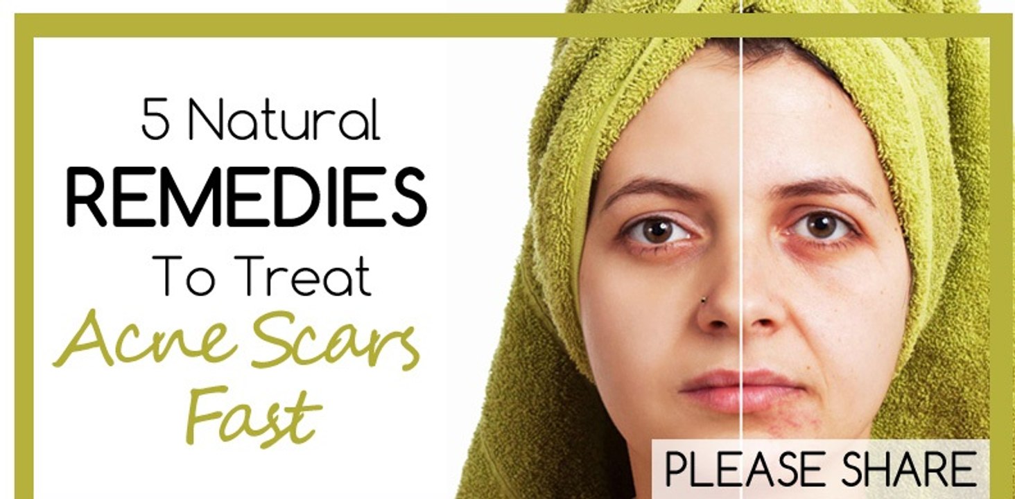 how to remove pimple scars| get rid of acne scars | How To Use Lemon For Scarring & Dark Spots | Naturally Healthy Skins