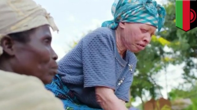Albinos killed in Africa: Violence against albinos on the rise in Malawi - TomoNews
