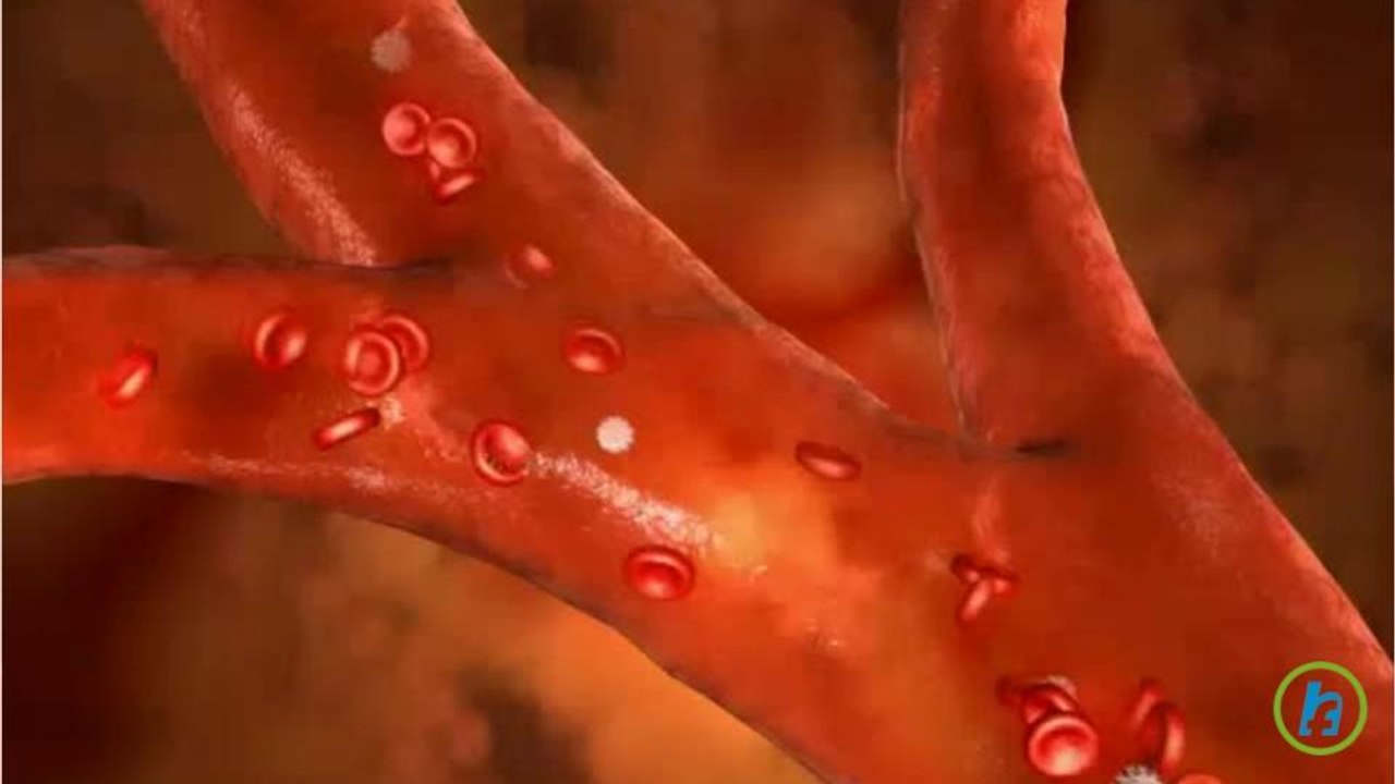 What is Peripheral Artery Disease?