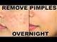 How To Remove Pimples Overnight - Acne Treatment