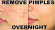 How To Remove Pimples Overnight - Acne Treatment
