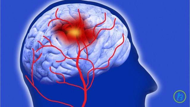 What are Strokes? FAST Facts on How to Prevent, Treat, and Manage A Stroke