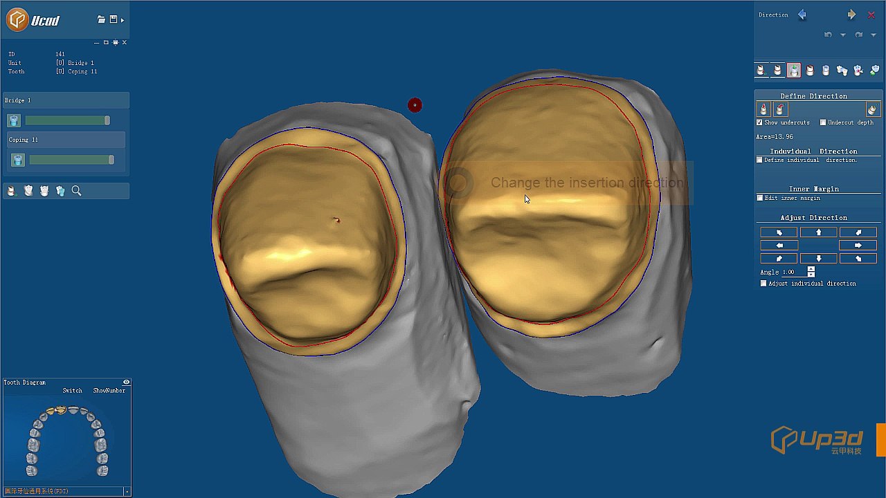 How to design the dental copings on anterior teeth