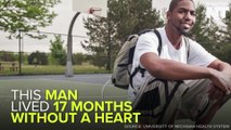 This Man Lived 17 Months Without A Heart