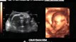 Gravimagem 12756 ultra som morfológico 3D 4D em gravidez com 26 semanas