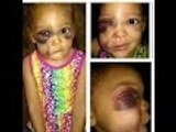 **UPDATE** Justice For AvaLynn- 5 Year Old Brutally Beaten At School