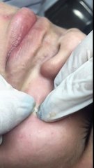 Nặn mụn tại Venice Spa