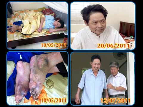Cách điều trị bệnh gút hiệu quả - Phòng khám đa khoa Viên Gút
